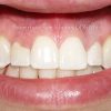 1 Esthetic Crown Lengthening Before_preview