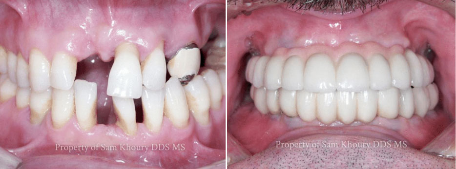 Full Mouth Implant Reconstruction