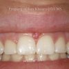 3-Esthetic-Crown-Lengthening-Before_preview-1