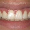 4-Esthetic-Crown-lengthening-After_preview-2