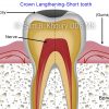 1-crown-lengthening-cavity-before