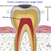 2-crown-lengthening-longer-tooth