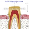 3-crown-lengthening-Cut-tooth